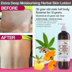 Before-After-photos-2-500ml-eczema-calm-scaled-1