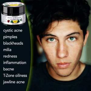 boy.jpeg-cystic-acne.jpeg